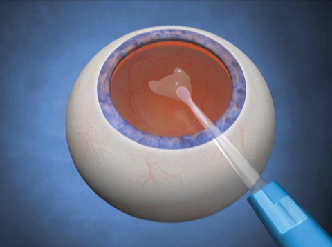 Slow injection of the Visian ICL.