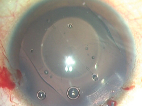 New CentraFLOW model, which has a hole in the center so one does not need an iridectomy.