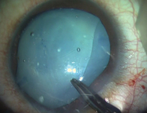 Posterior chamber phakic IOL with cataract.