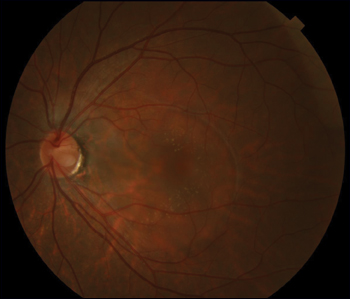 Fundus photo of left eye