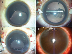 The procedure of glued IOL in a case of coloboma of the lens. Superior lens coloboma (a). Lensectomy with vitrectomy (b). Haptic externalization in process (c). First day postoperative with a small air bubble seen in the anterior chamber (d).