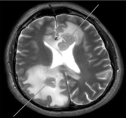 Axial MRI with gadolinium T2 weighted demonstrating homogenous mass-like enhancement of the genu and splenium of the corpus callosum (arrows) with surrounding edema.