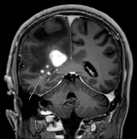 Coronal MRI with gadolinium T1 weighted demonstrating enhancing lesions subependymal to the lateral ventricles (arrow).