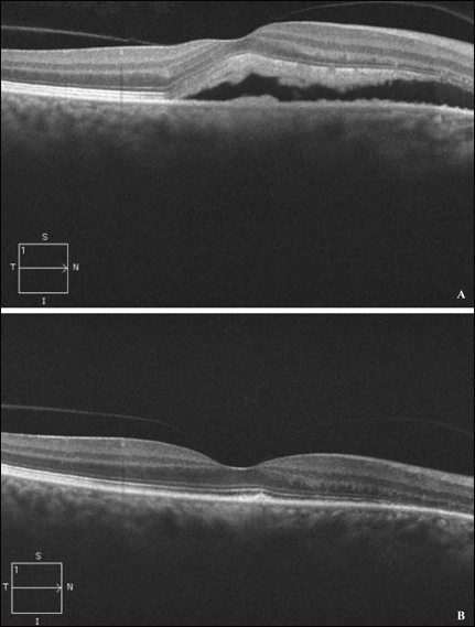 OCT showing progressed SRF 3 months after initial presentation (a). Five months post-PDT OCT showing complete resolution of SRF (b).