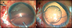 Silicone oil removal proceeded with transpupillary method (a). Glued IOL implantation done (b).