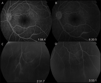 Fluorescein angiography of the left eye. Mid-phase hyperfluorescence focally around vein in inferior arcade (a). Late-phase staining along same region (b). Right eye peripheral venous staining (c). Left eye peripheral venous staining (d).