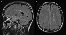 MRI FLAIR images showing focal periventricular hyperintensities. Saggital section (a). Coronal section (b).