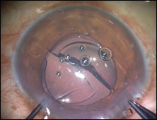 The offending IOL is rotated, and the optic is bisected.