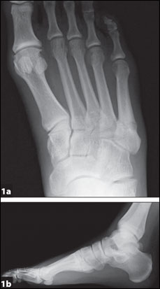 Preoperative radiographs of right foot.