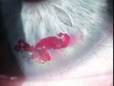 Corneal Hemorrhage