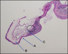 Wide angle histologic image showing the entire conjunctival lesion. Note the consistent organization with surface epithelium (arrow A), stroma (arrow B) and endothelium (arrow C). The circle denotes the location of the next figure.