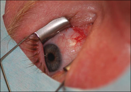 Immediate post-excision conjunctiva showing complete removal of the lesion with minimal hemorrhage.