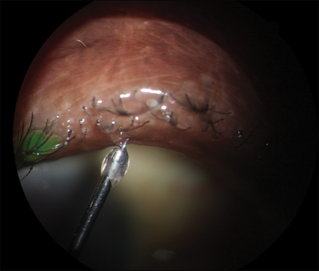 Intraductal injection of a steroid-antibiotic combination into the meibomian gland duct associated with an early chalazion.