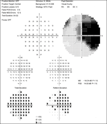 A central scotoma manifested in the visual field of the right eye.