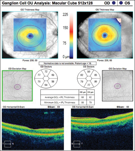 The GCC is below average nasally in the right eye, normal in the left.