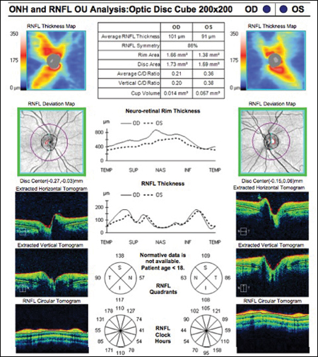 The ONH and RNFL analysis returned normal results in both eyes.