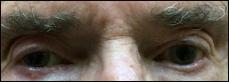 Top photo shows primary gaze with fixation in the right eye. Bottom photo shows primary gaze with fixation in the left eye. 