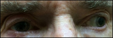 Top photo shows primary gaze with fixation in the right eye. Bottom photo shows primary gaze with fixation in the left eye. 