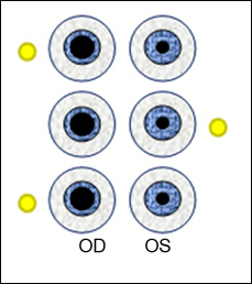 A fixed right pupil with no APD.