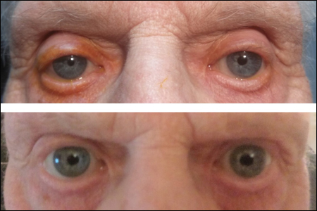 On initial evaluation, this patient has right ptosis and miosis, which typically sparks concern for Horner’s syndrome. However, upon further evaluation, the amount of anisocoria noted is greater in bright light (top photo), not in the dim light (bottom photo), as one would expect in Horner’s syndrome. The patient was asymptomatic, with no pertinent systemic symptoms. The patient underwent 0.125% pilocarpine testing to rule out Adie’s pupil (in the left eye) and apraclonidine testing on a separate day to rule out Horner’s syndrome (in the right eye), both of which were negative. Further investigation revealed the use of Kuglen hooks in vertical, horizontal and oblique meridians for pupil stretching during cataract surgery in the left eye a decade earlier. Anisocoria had been noted thereafter. Kuglen hooks are used in an effort to mechanically enlarge the pupil for surgery but cause tiny tears in the iris sphincter, leaving permanent damage in the sphincter muscle. In this case, it satisfies the reason for poor constriction in the left eye and anisocoria that is greater in the light than the dark.  