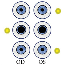 Pupillary reaction with a right APD.