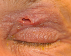 Presurgical appearance of the left upper eyelid fistula after drainage and débridement.