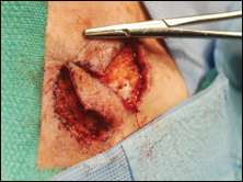 The corners of the rhombus are sutured first followed by equally-spaced interrupted sutures to close the wound.