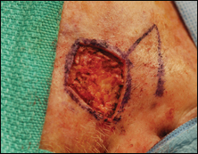 Excision of the lesion including a couple of millimeters of surrounding normal tissue.