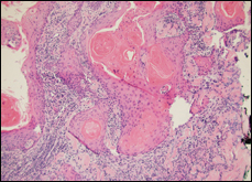 Histology slide showing a cyst-like tumor extending into the dermis with a base of irregular cell groups and nuclear atypia.