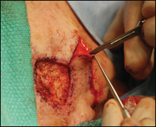 Rhomboid flap pedicle being fashioned.