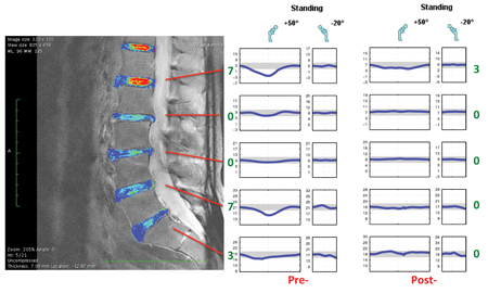 This shows standing lumbar range of motion changes in the spine at pre-flight and post-flight time points.