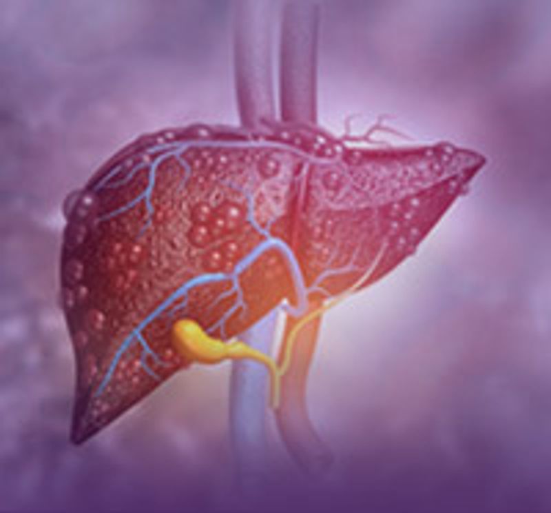 livercirrhosis