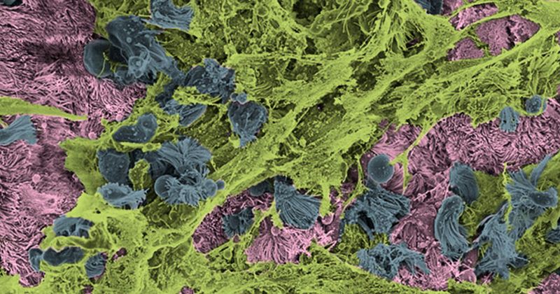 This colorized microscope view shows healthy cells (pink), mucus (green) and cells in the process of cell death (blue). Credit: Ehre Lab, UNC School of Medicine. 