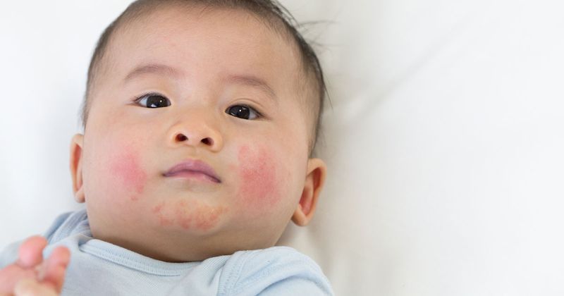 Interventions that target specific bacteria may mitigate or prevent the development of eczema in infants. Image: Adobe Stock