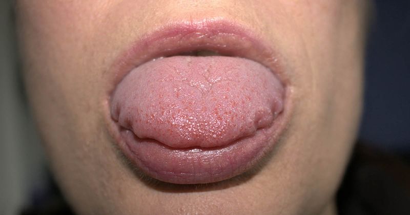 swollen tongue