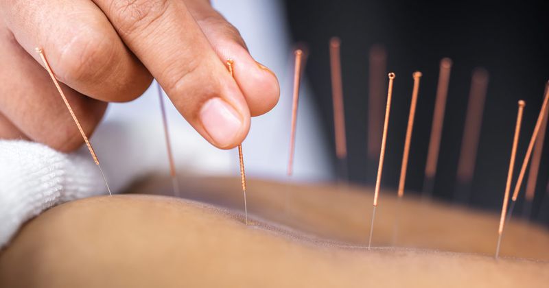 Acupuncture