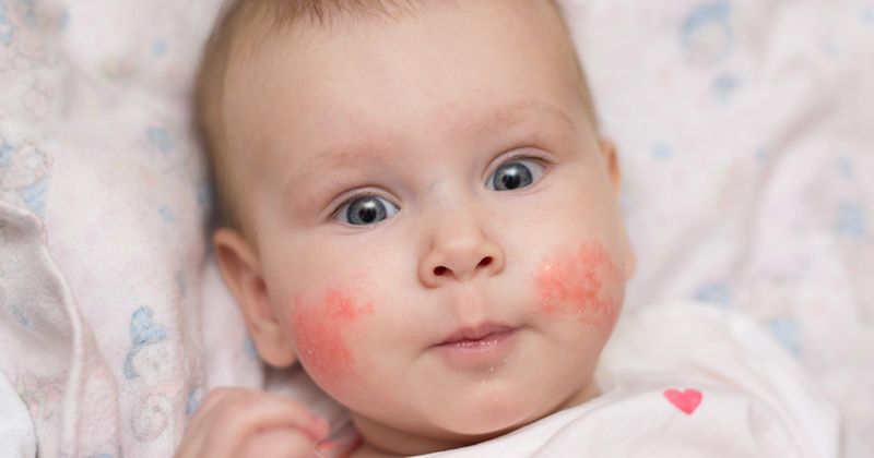 baby with atopic dermatitis