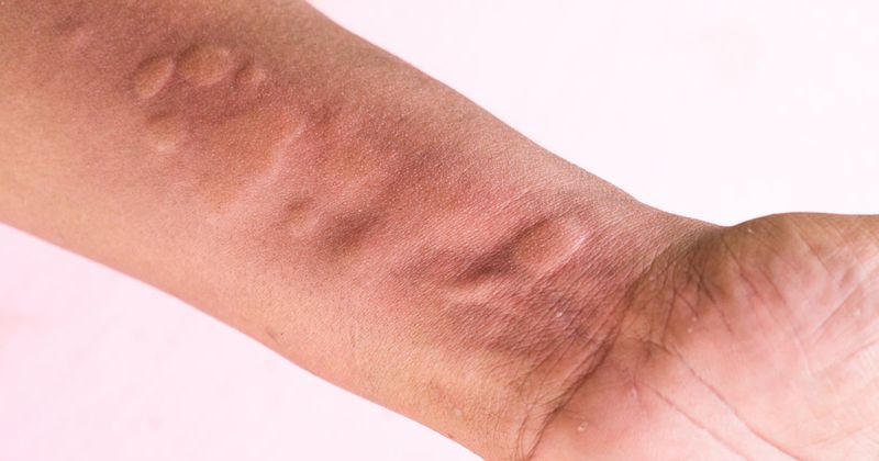 chronic spontaneous urticaria