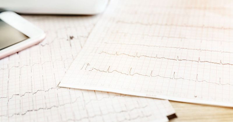 Atrial fibrillation on ECG