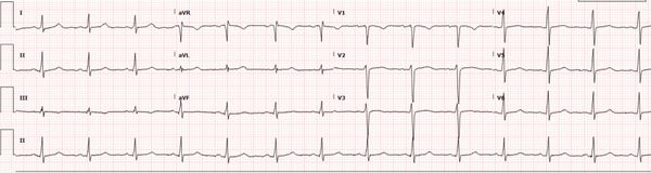 Baseline ECG