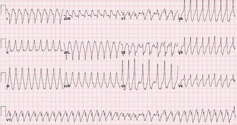 missing ecg