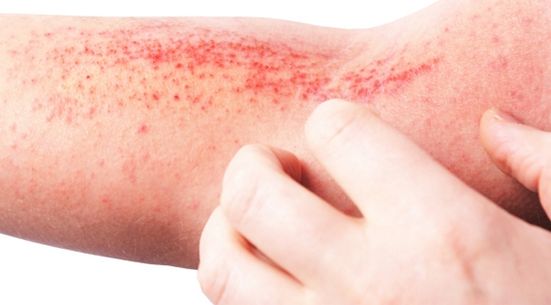 Atopic allergy on the arm.