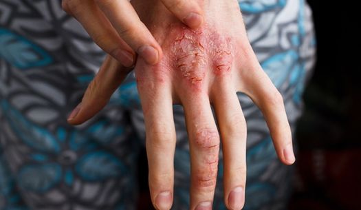 Atopic dermatitis on the hand.