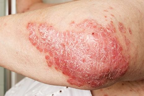 Psoriasis on the elbow