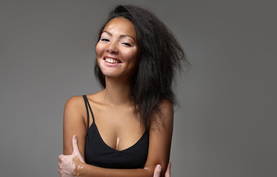 Woman smiling with vitiligo 