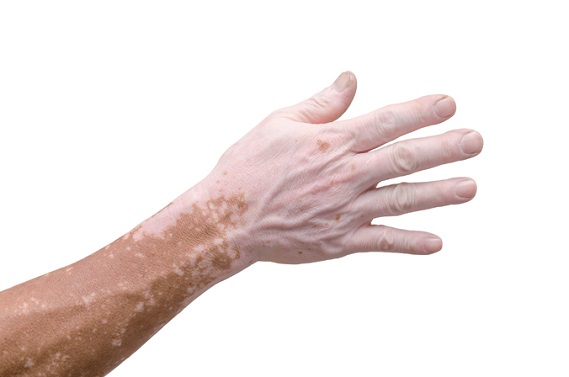 Hand with vitiligo