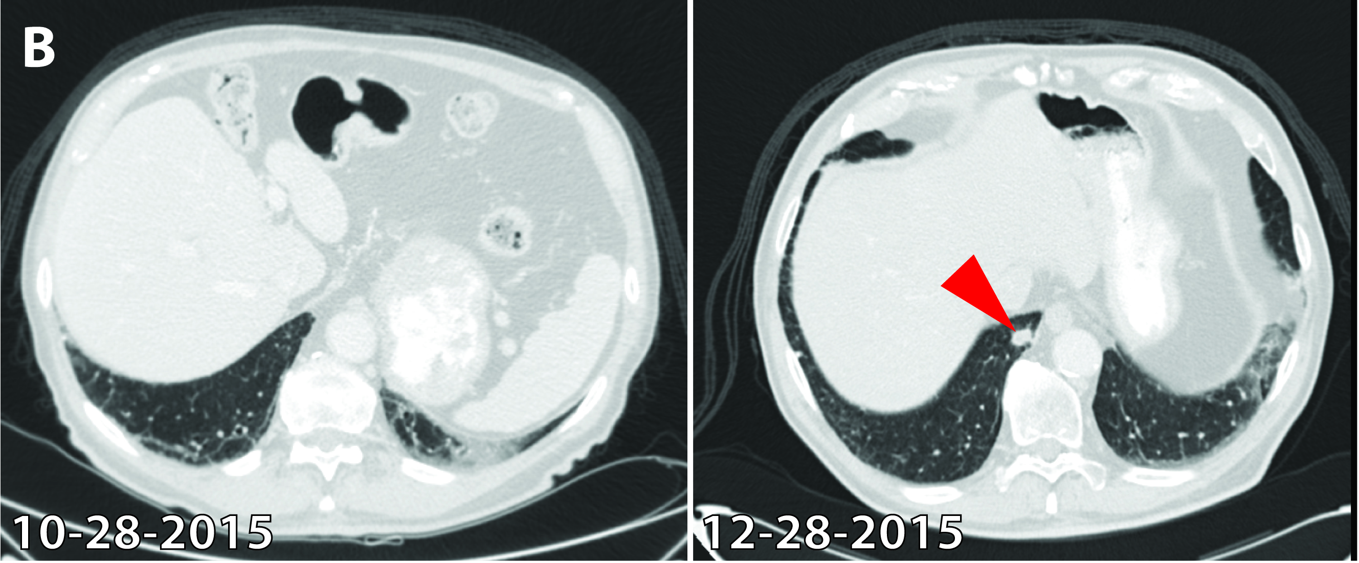 CT image of a chest