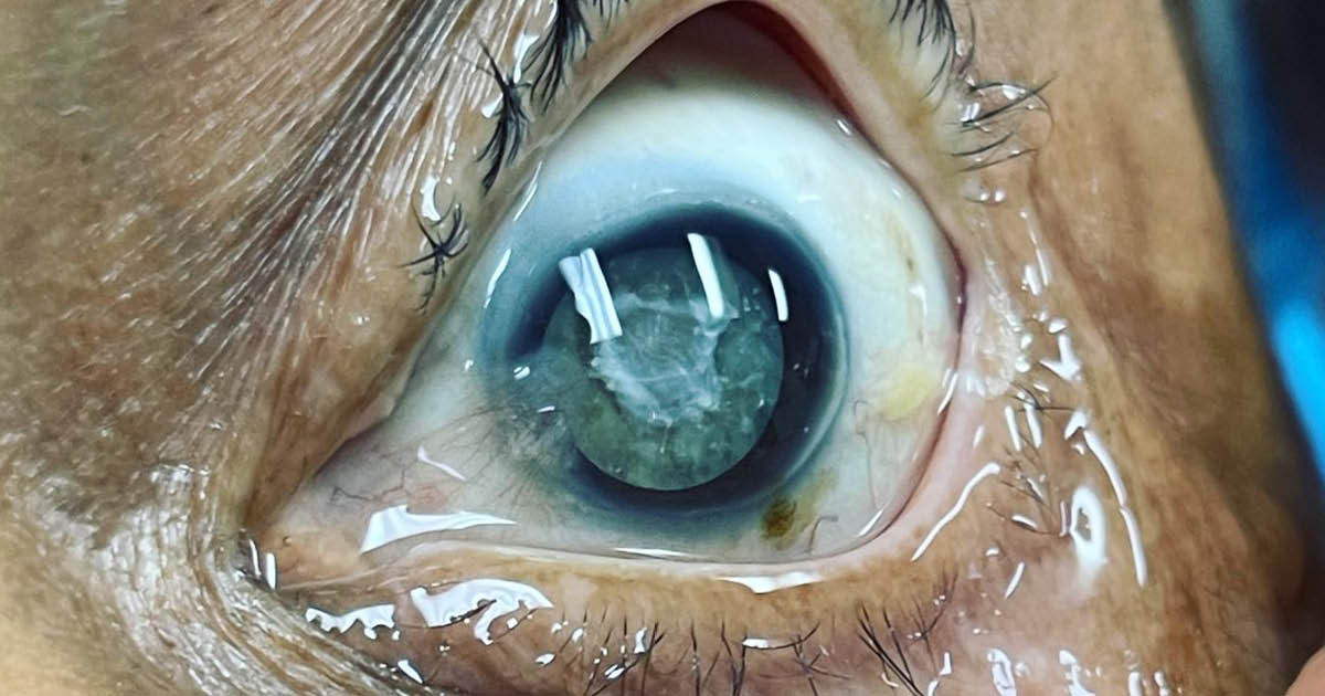 'Mission fever' figure 2: dense cataract