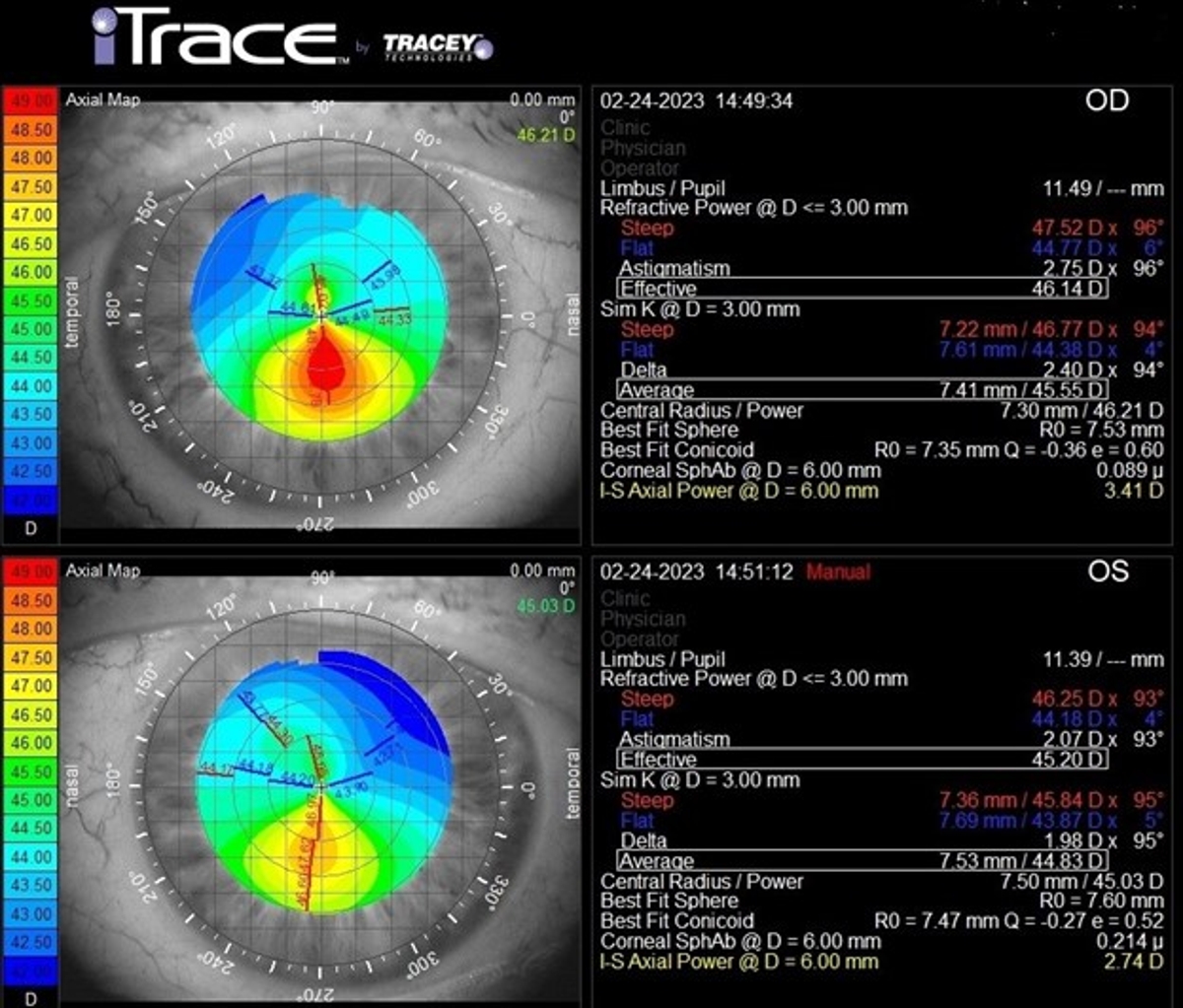 Jared Younger, MD, Figure 4: topography shows a classic asymmetric bow tie pattern with an axis that is not radially skewed in a pateint with stable keratoconus