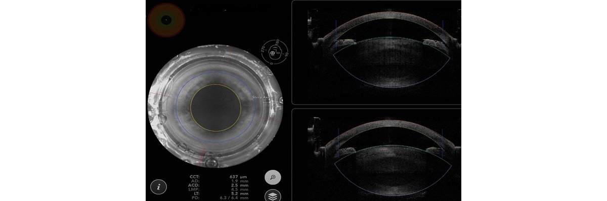 Because the lens meridian position is 4.5 mm, the IOL is likely to sit more anteriorly in the capsular bag.